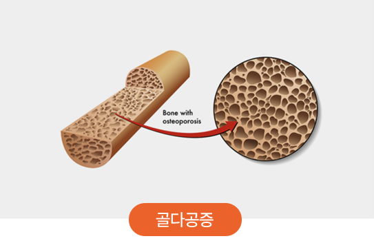 골다공증