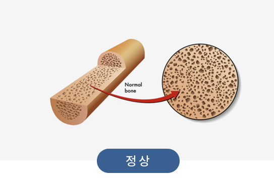 골밀도 정상