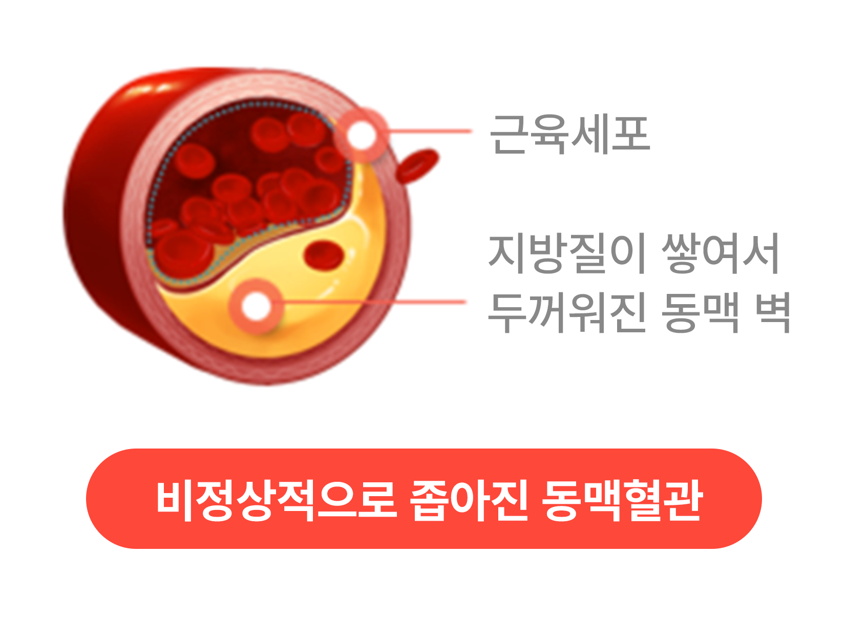 비정상적으로 좁아진 동맥혈관